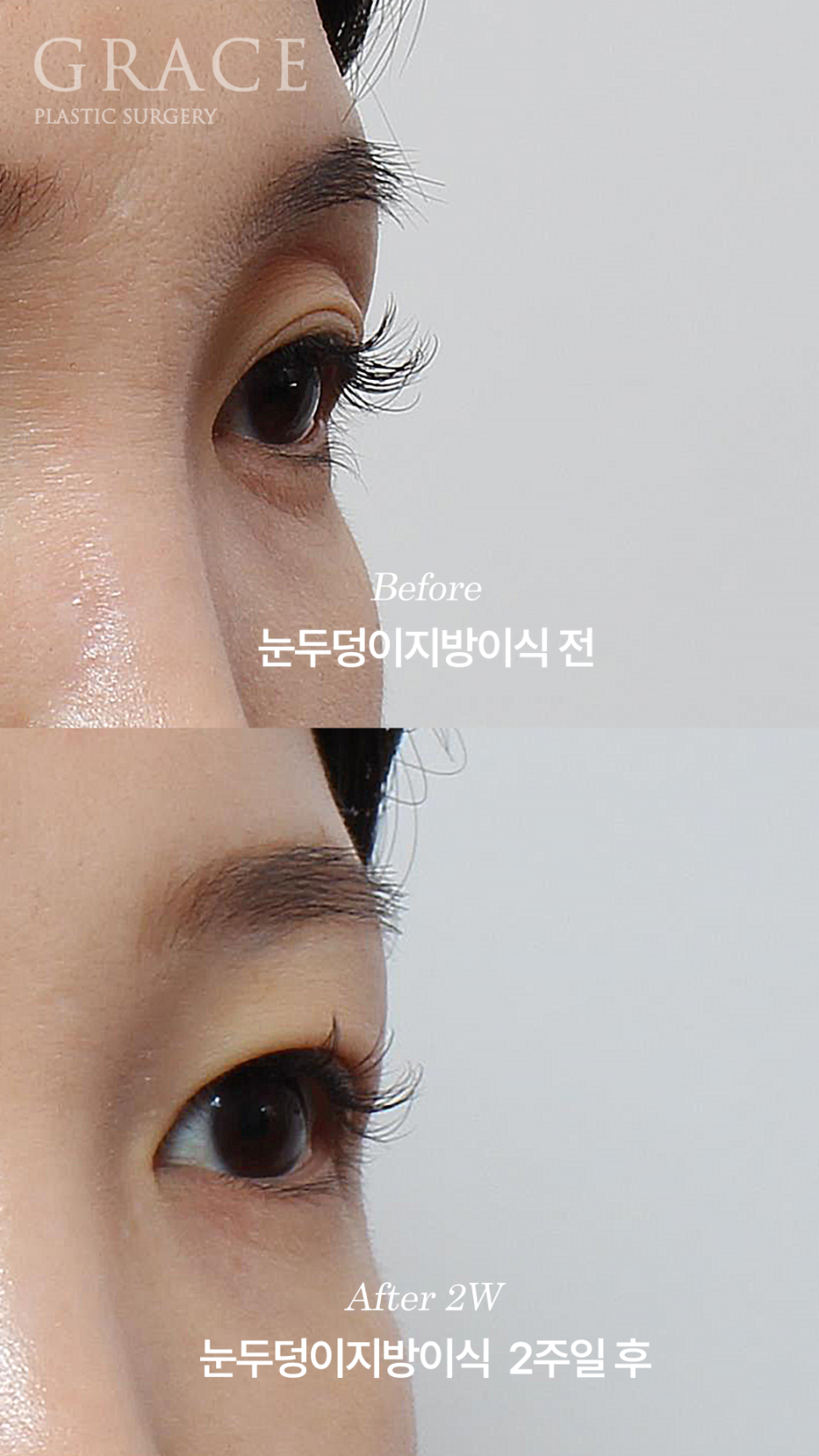 Double Eyelid Fat Grafting Fails When It Becomes Visible and Bumpy? image 6