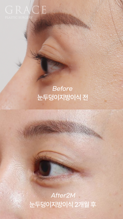 Eyebrow Fat Grafting &middot; Eyelid Fat Grafting &middot; Sunken Eyes Surgery Cost Information (As of June 2025) image 12