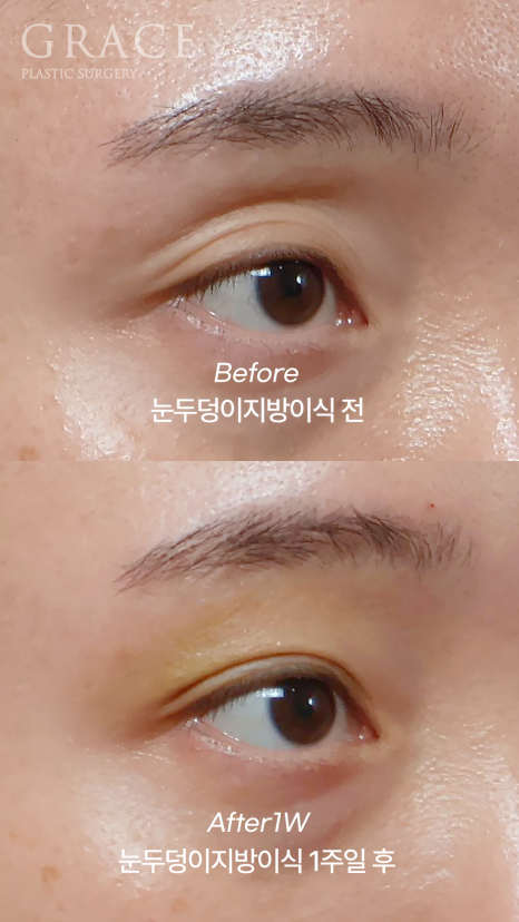 Understanding the Difference Between Forehead Fat Grafting (Eye Hollow Fat Grafting) and Fillers image 4
