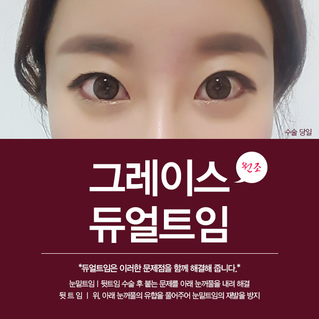 눈 커지는 법?! 그레이스성형외과 듀얼트임으로 또렷해지자! 관련 이미지 4
