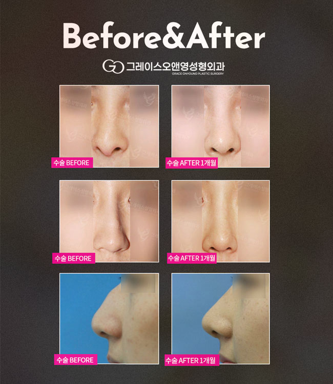 Crooked nose? A nose that keeps getting blocked? With functional rhinoplasty! image 3