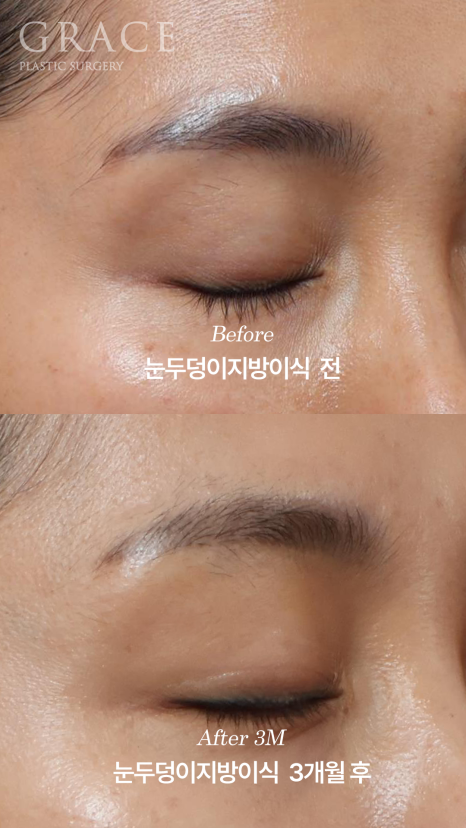 안와지방 주입 &middot; 눈두덩이지방이식 (1cc / 0.9cc) 관련 이미지 6