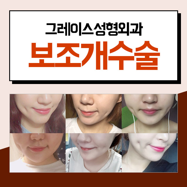 보조개수술후기 만족스러워! 관련 이미지 3