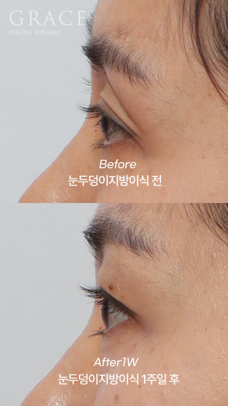 Sagging Eye Hollows and Sunken Eyelid Fat Grafting: Reasonable Cost (Price) Information and image 8