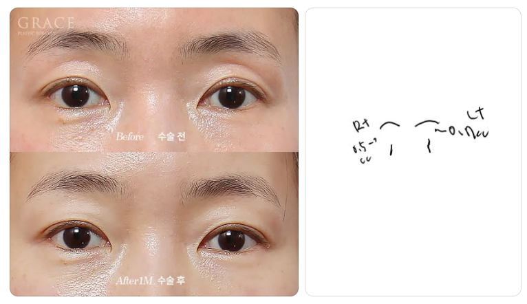 The Real Cause of Side Effects from Upper Eyelid Fat Grafting: the Injection Layer (Orbicularis Oculi Muscle & Orbital Fat) image 2