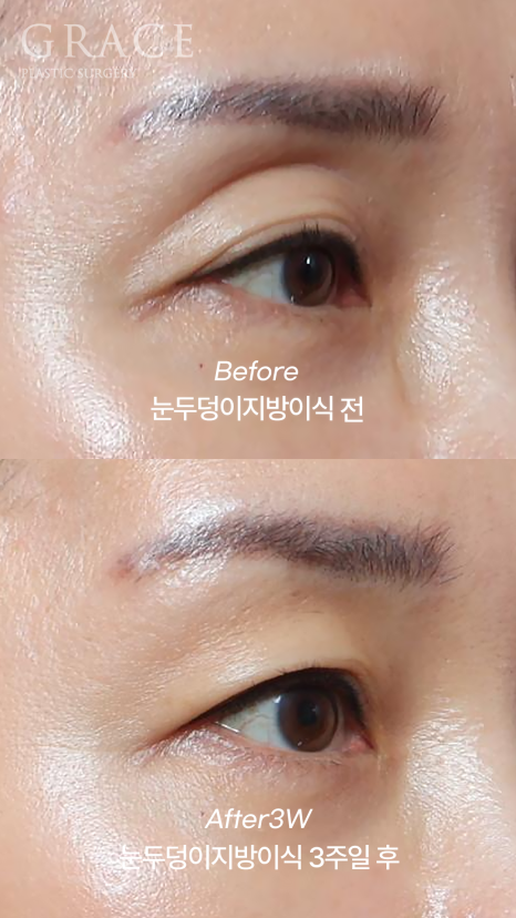 Celebrities with Sunken Eye Hollows, Filler Issue? Upper Eyelid Fat Grafting image 6