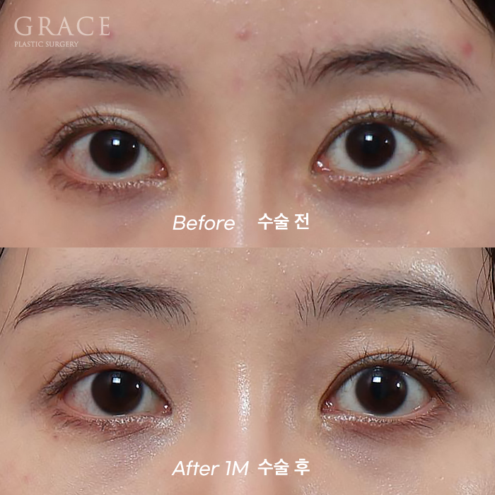 For Those Saddened by Sunken Eyelids (Upper-Eyelid Fat Grafting) image 10