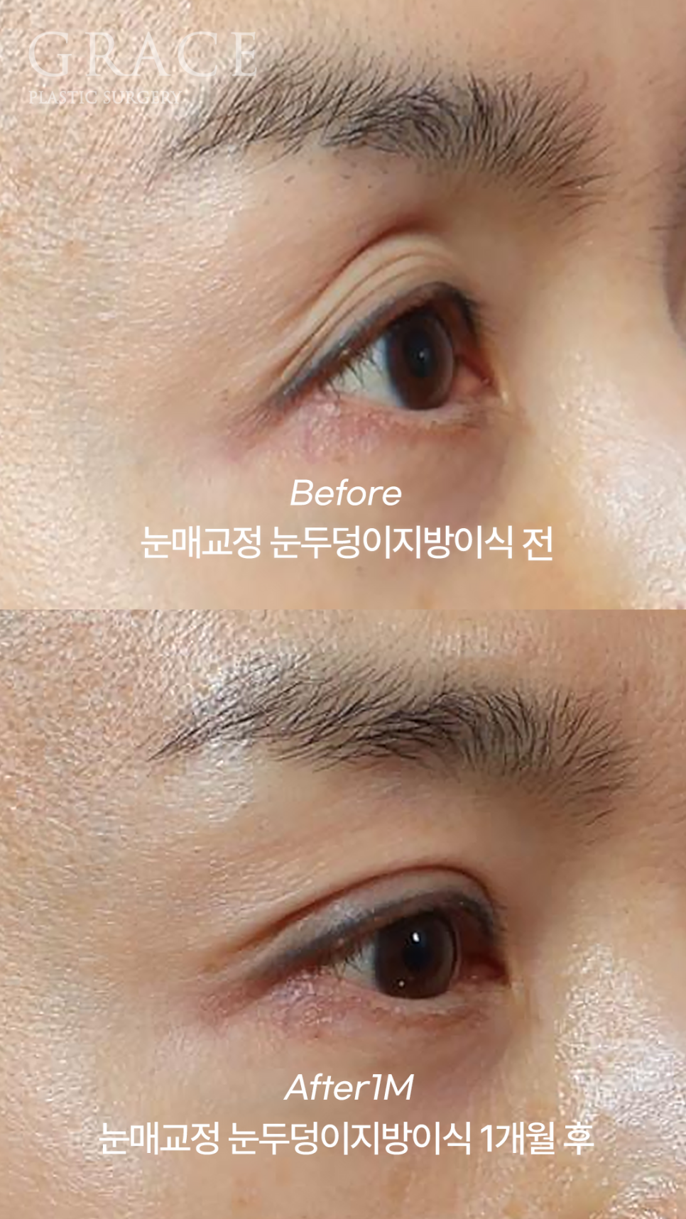 Sunken Upper Eyelids: Fillers or Fat Grafting? image 5