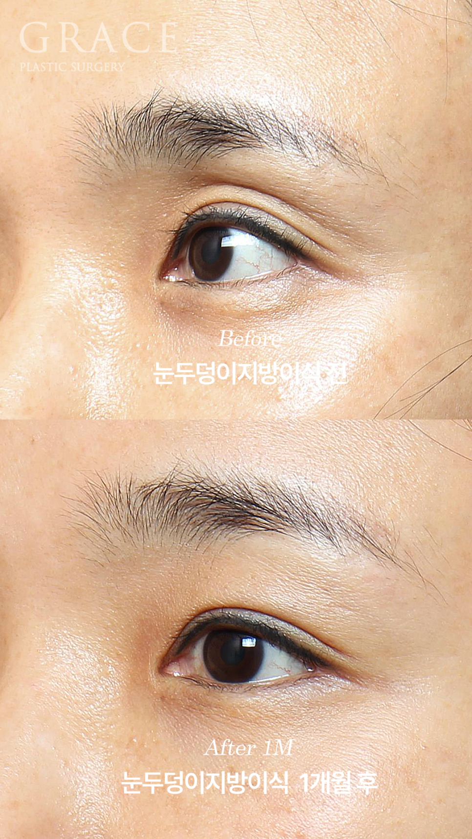 그레이스성형외과 눈두덩이 꺼짐 지방이식 전후 비교 관련 이미지 3