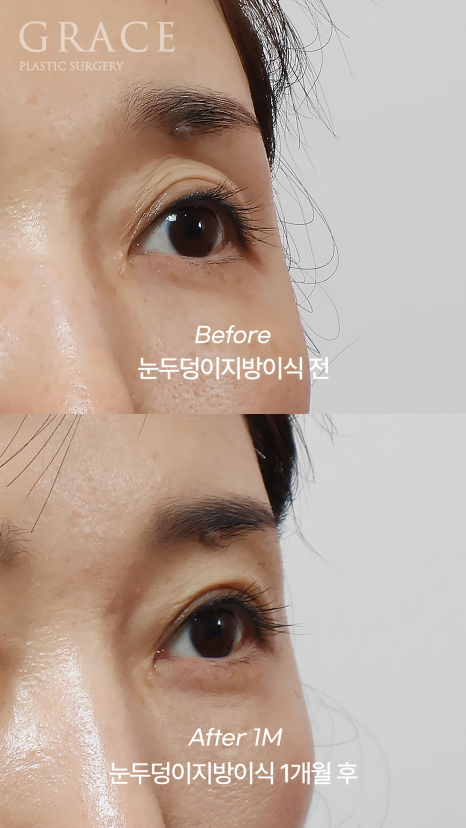 Eyelid Fat Grafting Side Effects? How to Settle In Beautifully Without Lumps image 8