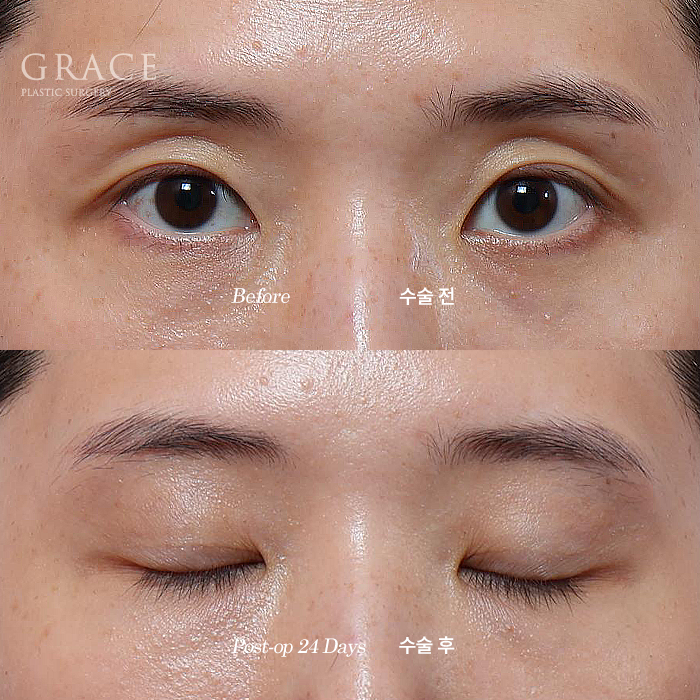 Will a Sunken Upper Eyelid Become Bumpy When You Close Your Eyes After Fat Grafting? image 7