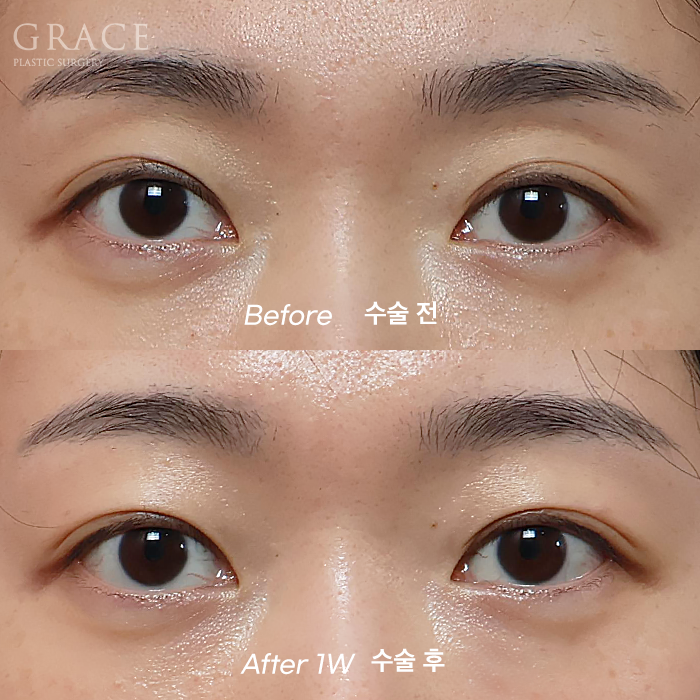 No to Frozen Fat That’s Completely Frozen! Eyelid Fat Grafting with Only Fresh Autologous Fat image 2