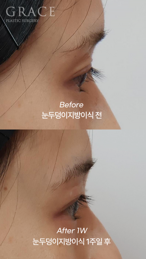 눈꺼풀 지방이식 눈 감았을 때 울퉁불퉁하지 않는 이유 전후사례로 보여드립니다 관련 이미지 9