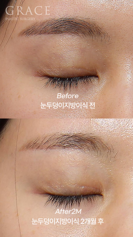 Upper Eyelid Fat Grafting That Shows When You Close Your Eyes? The Cause of Side Effects Is Different image 2