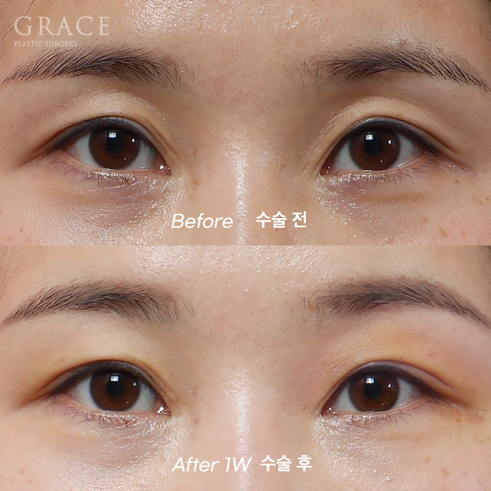 …The Result of Eyelid Fat Grafting (If You’re Worried About Side Effects and Swelling) image 9