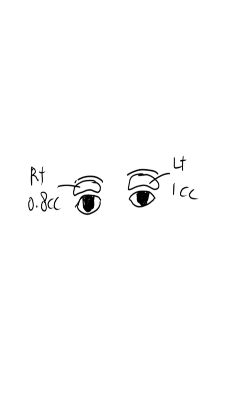 The Key to Improving Sunken Eyelids with Orbital Fat Grafting Is Placement, Not Volume image 2