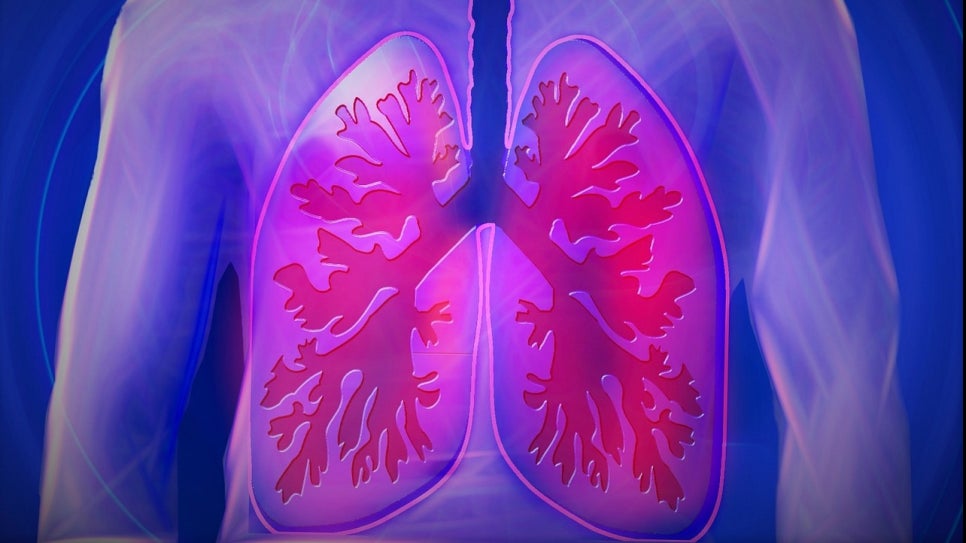About Pneumothorax image 1
