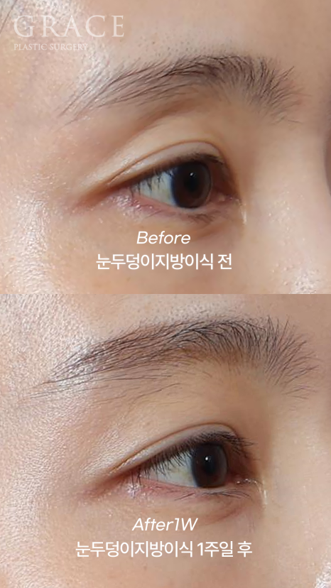 눈두덩이지방이식 30대 초반 전후 가격·부작용·후기까지 관련 이미지 4