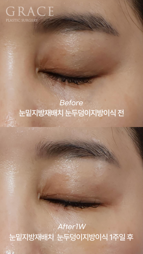 Under-Eye Fat Repositioning & Eyelid Fat Grafting: Double the Swelling? Before and After 1 Week image 6