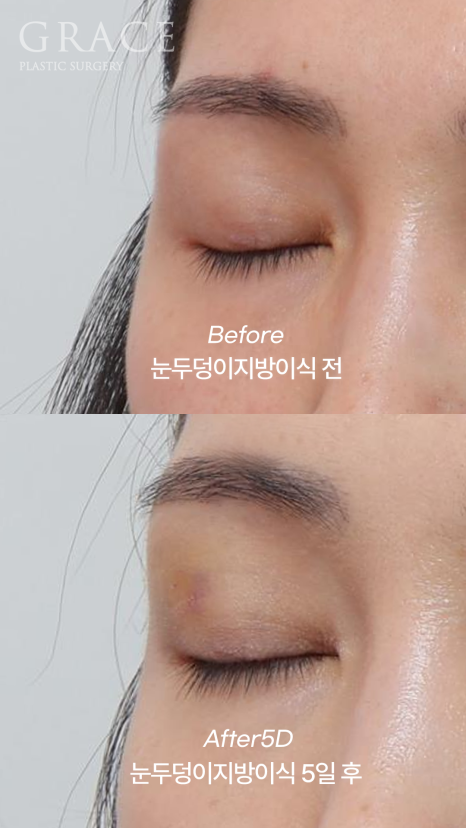 Eyelid Fat Grafting Bruising and Swelling Side Effects (Natural Eyelid Line After 5 Days) image 5