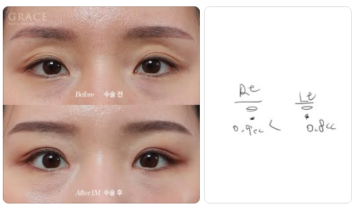 꺼진 아이홀 지방이식, 울퉁불퉁 부작용 오해 바로잡기 관련 이미지 6