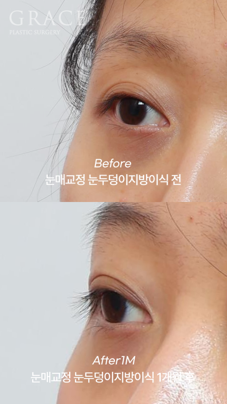 꺼진 눈두덩이 필러 대신 지방이식? 붓기&middot;부작용 없는 방법 정리 관련 이미지 5