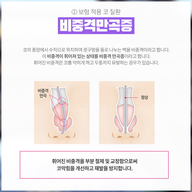 How Can You Reduce the Burden of Crooked Nose Surgery Costs? image 5