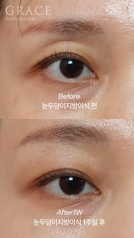 Sunken Eyelid Fat Grafting: Swelling After 1 Week Before & After image 2