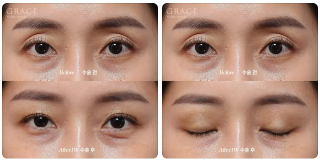 After eyelid fat grafting, do scars remain when you close your eyes? One week later... is this a failure? image 1