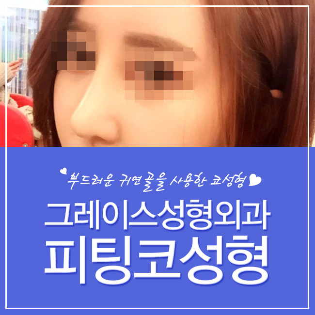 그레이스성형외과 피팅코, 자유자재로 움직이는 코성형의 완성! 관련 이미지 3