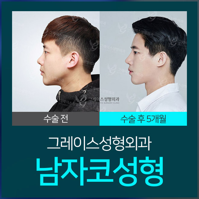 코성형수술잘하는곳 남자코성형까지 관련 이미지 2
