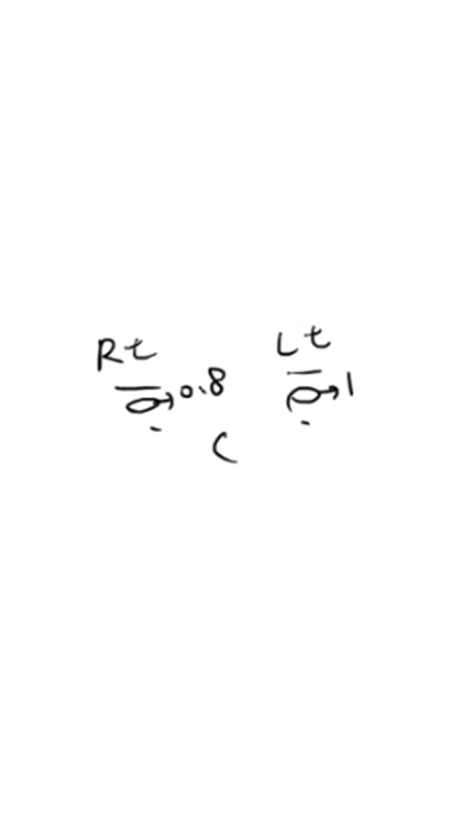 눈두덩이 지방이식 or 풀페이스 지방이식 유지기간&middot;부작용까지 정리 관련 이미지 11