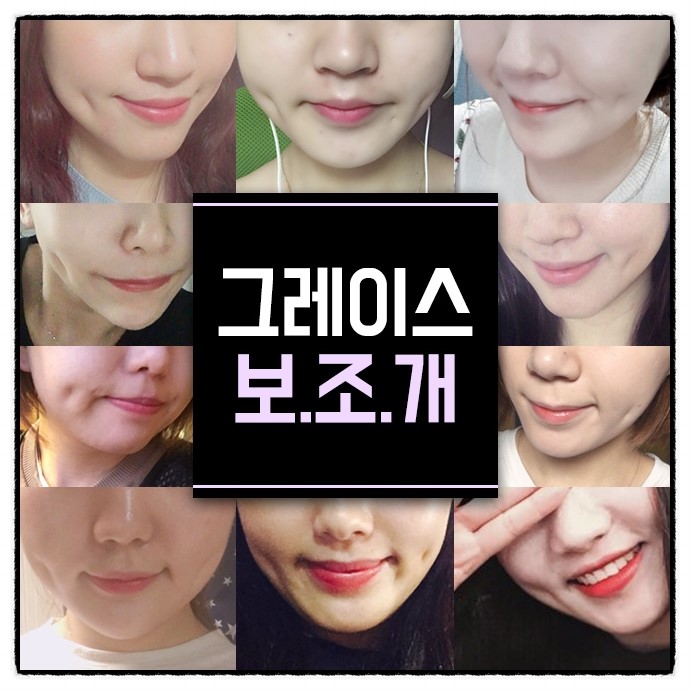 보조개수술후기 보고 심쿵한 매력♡ 관련 이미지 5