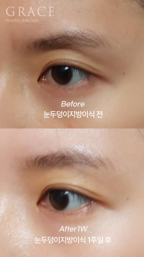 Recovery Timeline Before and After Eyelid Orbital Fat Grafting: 1 Week image 6