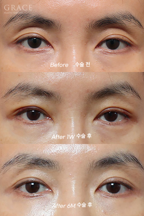 눈꺼풀 지방이식+눈매교정  40대 (눈 감았을 때 눈두덩이 흉터&middot;부작용 체크) 관련 이미지 1