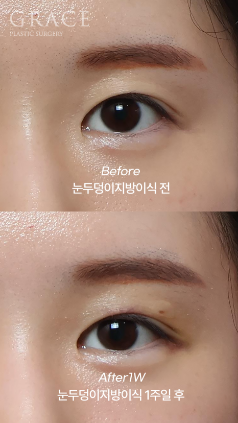 아이홀 꺼짐은 MZ도 예외 없다 눈두덩이 지방이식으로 짝눈교정 관련 이미지 2