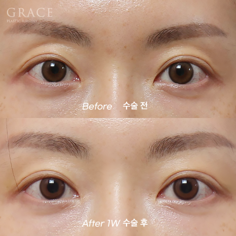 Upper Eyelid Fat Grafting Cost · Swelling, Reviews & Side Effects image 8