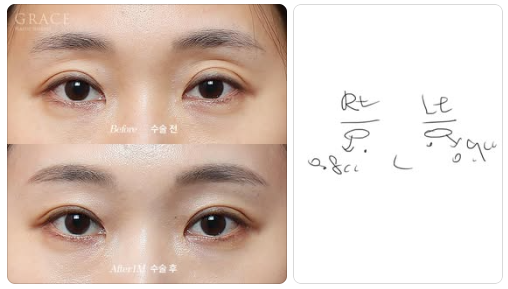 꺼진 아이홀 지방이식, 울퉁불퉁 부작용 오해 바로잡기 관련 이미지 4