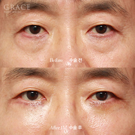 Side Effects of Under-Eye Fat Repositioning? Common Traits of People Who Say It Went Wrong image 10