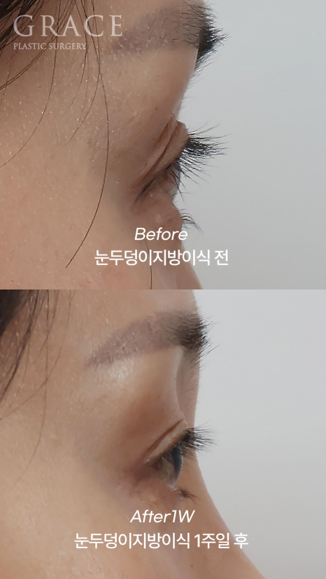Sunken Upper Eyelids? With Just 0.9cc of Injection for Eye Hollow Fat Grafting image 7