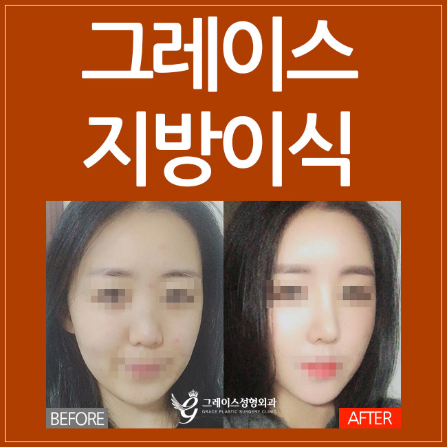 얼굴지방이식후기, 그레이스성형외과에서 알아봐! 관련 이미지 4