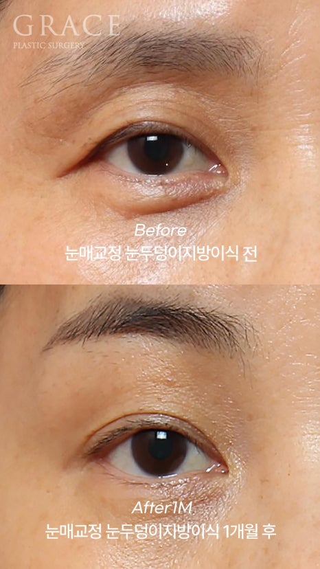 Eyebrow Hollow Fat Grafting Before and After Comparison – Gently Filling Sunken Eyes image 14