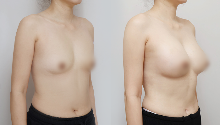 가슴성형 40대인데 355cc 괜찮을까? 관련 이미지 2