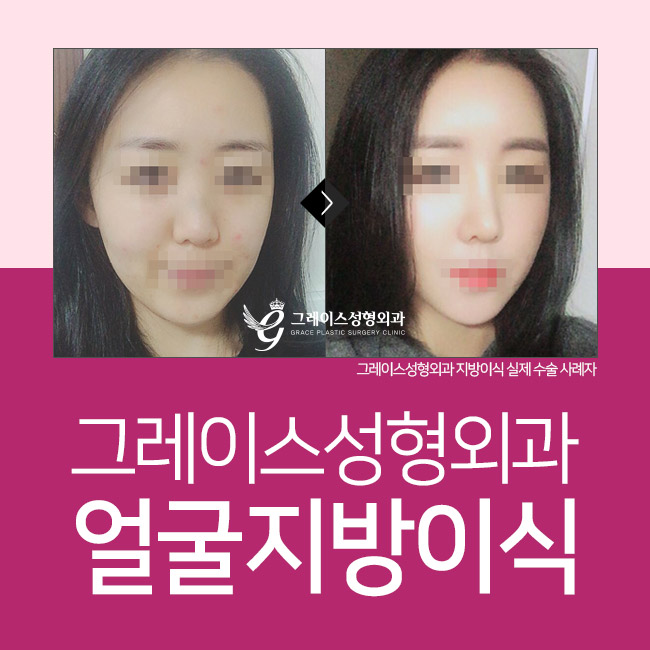 얼굴지방이식 탱탱하고 매끈한 동안얼굴을 원한다면 관련 이미지 2
