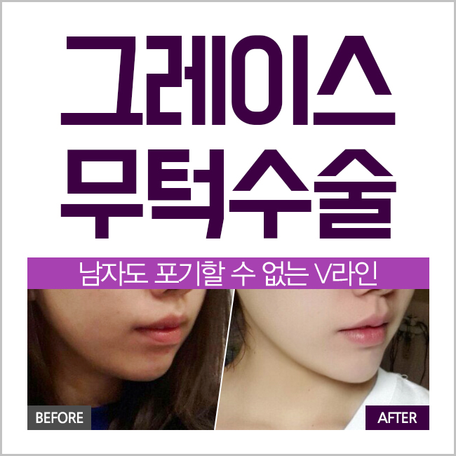 돌출입교정전후, 신사역 그레이스성형외과 무턱수술 관련 이미지 3