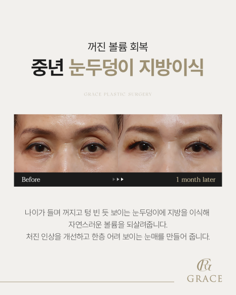 50대 절개눈매교정과 눈위지방이식 붓기는 얼마나 가나요? 관련 이미지 14