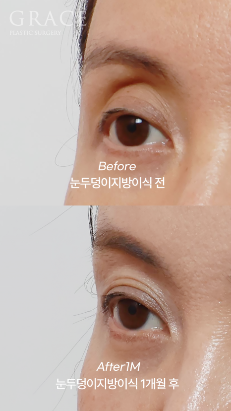 눈꺼풀 지방이식 보법이 다른 최문섭 원장님 실력 관련 이미지 8