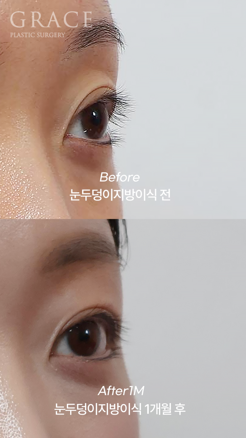 눈두덩이 지방이식 20대 후기 (3개월 후 2차 생지방으로 이식) 관련 이미지 3