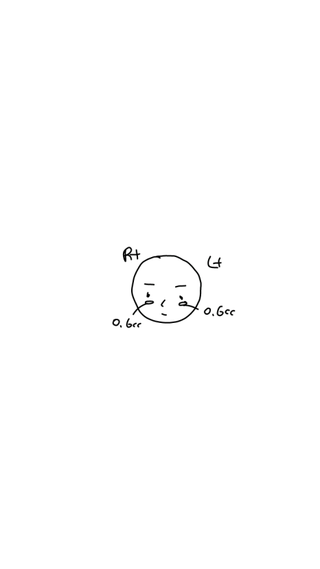 Side Effects of Under-Eye Fat Repositioning? Common Traits of People Who Say It Went Wrong image 2