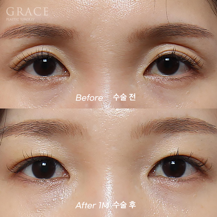 Upper Eyelid Fat Grafting Side Effects? The Difference in Survival Rates Between Frozen Fat and Fresh Fat image 9